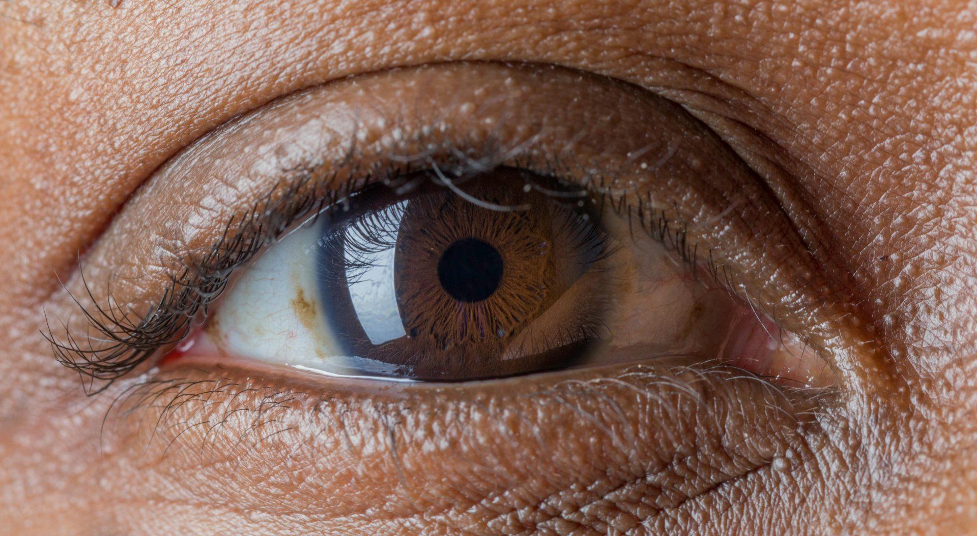 Algeria eliminates trachoma after decades-long health campaign